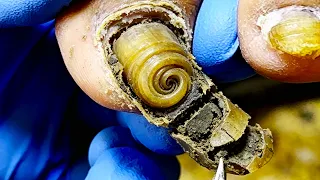 You've Never Seen Such Long Toenails Before! Wonderful【Xue Yidao】