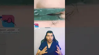 قطرات اللاتي لتطويل الرموش لاتيس  الجلوكوما  ارتفاع ضغط العين  رموش  رمش  د مصعب حسوا  ثقف نفسك طبيا دندنها