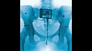 Lorde David Extended 