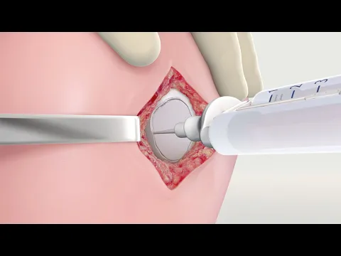 Video: MACI Surgical Animation: Surgical Technique