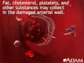 Atherosclerosis Anatomy MedlinePlus Medical Encyclopedia