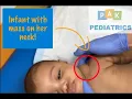 Infant with mass on her neck Cystic Hygroma