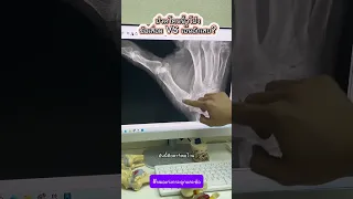  นิ้วโป้งบวมและปวดเมื่อใช้งานบ่อย ๆ เกิดจากสาเหตุอะไร 