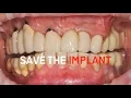Download Lagu Implant maintenace with GBT (Guided Biofilm Therapy)