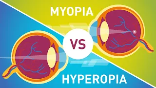 Download Difference between Myopia (Near Sightedness) \u0026 Hyperopia (Far-Sightedness) MP3