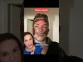 Dermatologist Reacts To Aggressive Chemical Peel For Acne Scarring