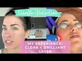 Download Lagu MY EXPERIENCE: CLEAR AND BRILLIANT LASER FOR MELASMA/ HYPERPIGMENTATION