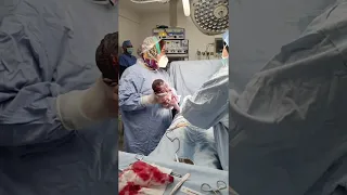 الولادة القيصرية المتكررة 