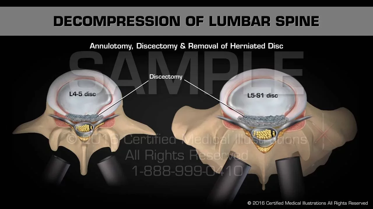 Simple tests for Pathology of the Lumbar spine of L4, L5 & S1 nerve roots. 