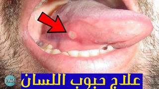 علاج حبوب اللسان البيضاء 