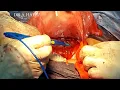 Download Lagu BEST CAESAREAN SECTION TECHNIQUE