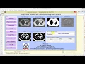 Lung Cancer Detection and Classification Using Neural Network Matlab Project Source Code