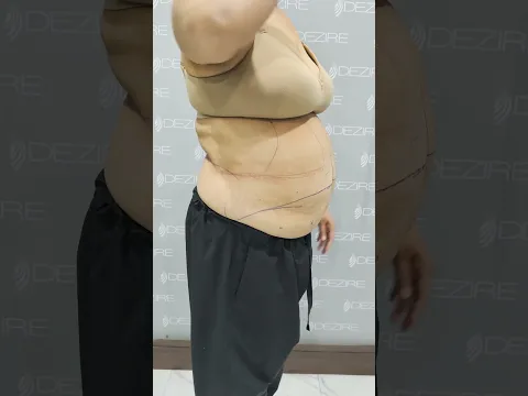 Tummy Tuck Surgery with back Liposuction result