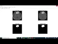 Brain Tumor Detection and classification using CNN Engineering Project Final Year Project