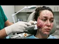 Blackheads Infected Pimple Popping Zits Whitehead Extraction Removal