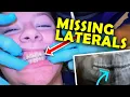 Invisalign Treatment for Missing Lateral Incisor the different options McKinney Orthodontist