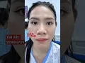 Download Lagu TẠI SAO ĐI NÂNG MŨI LẦN ĐẦU PHẢI CHỌN CƠ SỞ UY TÍN#nangmui #shorts #thammy #lamdep #drduc