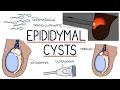 Lagu Understanding Epididymal Cysts