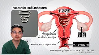 ห่วงคุมกำเนิดทำงานอย่างไร เพื่อป้องกันการตั้งครรภ์