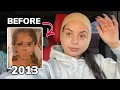 I GOT EAR SURGERY OTOPLASTY