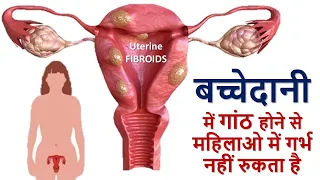  uterine fibroids home remedy fibroids
