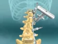 Download Lagu Scoliosis Spinal Fusion Animation