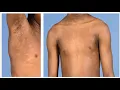 Lecture-89 Acquired disorders of Epidermal keratinization Part-I Rook s chapter 87