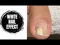 Why the Toenail Looks White Full Pedicure