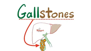 Gallstones Types -Cholesterol (yellow) vs. Pigmented -Cholecystitis,Cholangitis,Choledocholithiasis 