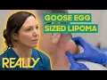 Download Lagu Dr. Emma Helps Patient With Goose Egg-Sized Lipoma On His Neck | The Bad Skin Clinic