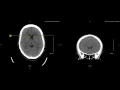 Unremarkable Non-Contrast CT Coronal Scan - Example 2