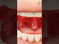 Download Lagu Tonsil Removal Surgery ↪ 3D Medical Animation #Tonsil #Tonsillectomy #Surgery #Shorts