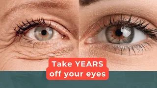 Everything you NEED to know about the CO2 Laser Eye lift