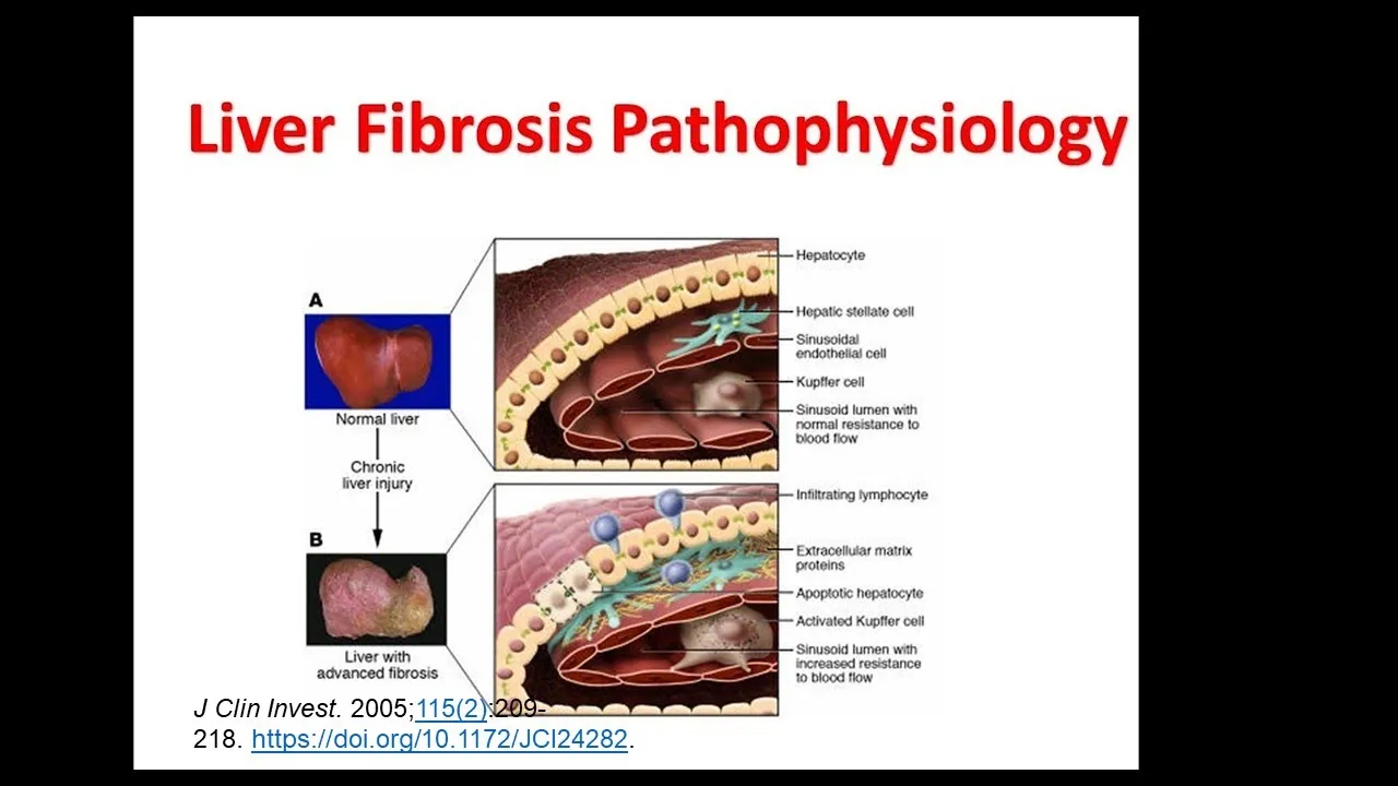 Liver fibrosis Pathophysiology and etiology| Liver Cirrhosis | Hepatic Stellate Cells| Liver cancer
