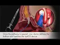 Sinus Dilation Animation For Patients Northeast Atlanta ENT