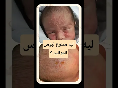 احذري هربس المواليد | امنعيهم من تقبيل ابنك