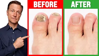 Download The REAL Cause of Toenail Fungus is ... MP3