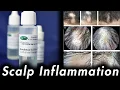 DHT Scalp Inflammation Tacrolimus and Clobetasol