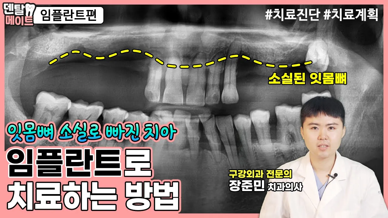 치아 대부분이 상실되었을 때 임플란트로 치료하는 방법 [만성치주염, 임플란트 케이스, 치료진단, 치료과정, 치료계획] | 덴탈메이트