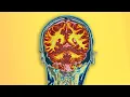 A Student Drank 2 Bottles Dextromethorphan This Is What Happened To Her Brain