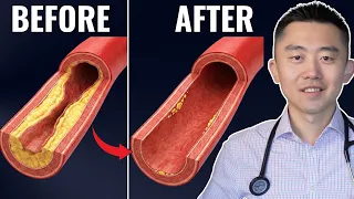 #1 Best Meal to UNCLOG Your Arteries (Backed by Science)
