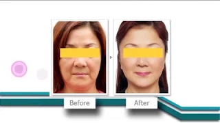 มุมปากตกเกิดจากสาเหตุอะไรบ้าง