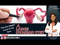 This Can Happen to you If you have A Large Ovarian Cyst - TheFibroidDoc