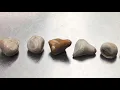 What You Need to Know About Kidney Stones