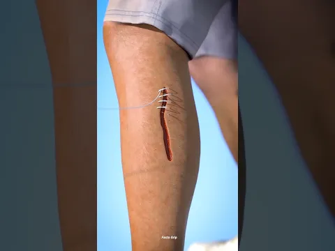 How Stitches Help Your Wound Heal: Step-by-Step Science#fact