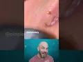 PAINFUL pimple pop on the lip line🤐 (credit: @pimplestory on TT) #pimple #reaction