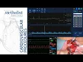 Download Lagu Transcranial Doppler Monitoring During CEA (Lumsden MD, Garami MD, Berczeli MD, Sinha MD, Tekula MD)