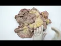 How to differentiate between jejunum and ileum
