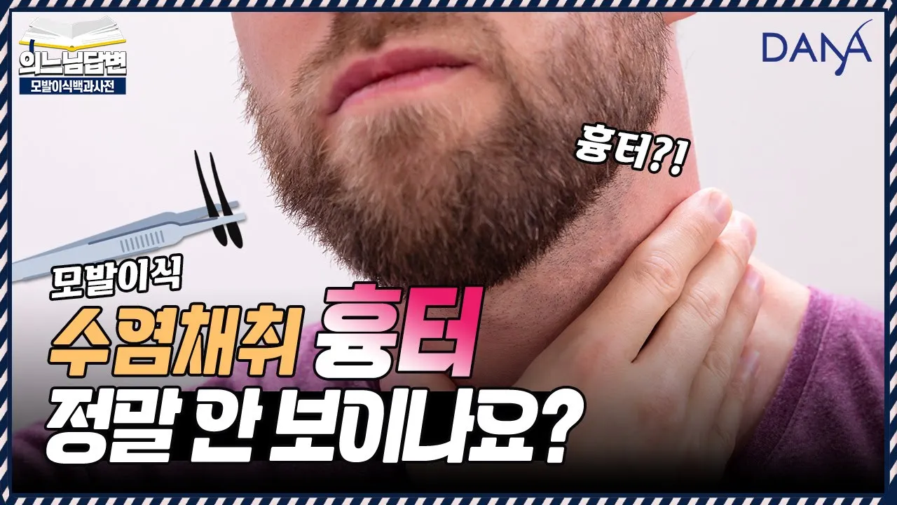 의느님답변📂수염채취 하면 정말 흉터가 안 보이나요?ㅣ모발이식 턱수염으로도 가능합니다 ㅣ다나성형외과(DANA)ㅣ모발이식ㅣ헤어라인교정ㅣ두피문신ㅣ탈모치료