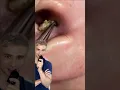 Satisfying Blackhead Removal